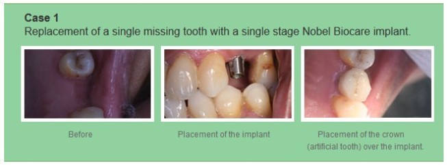 Dental implants India